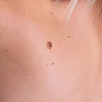 Zabieg dermatologiczny